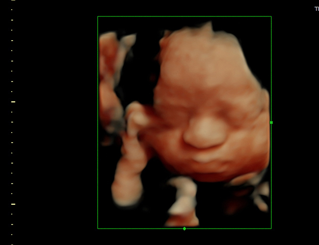 3D ultrasound image at 29 weeks